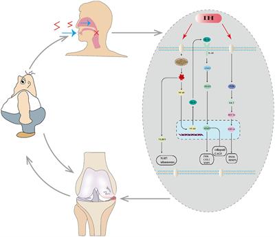 The common link between sleep apnea syndrome and osteoarthritis: a literature review